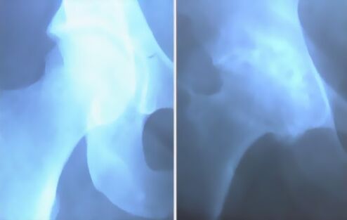 Schiuma di artrosi dell'articolazione del ginocchio