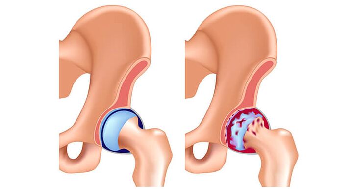 articolazione dell'anca sana affetta da osteoartrosi